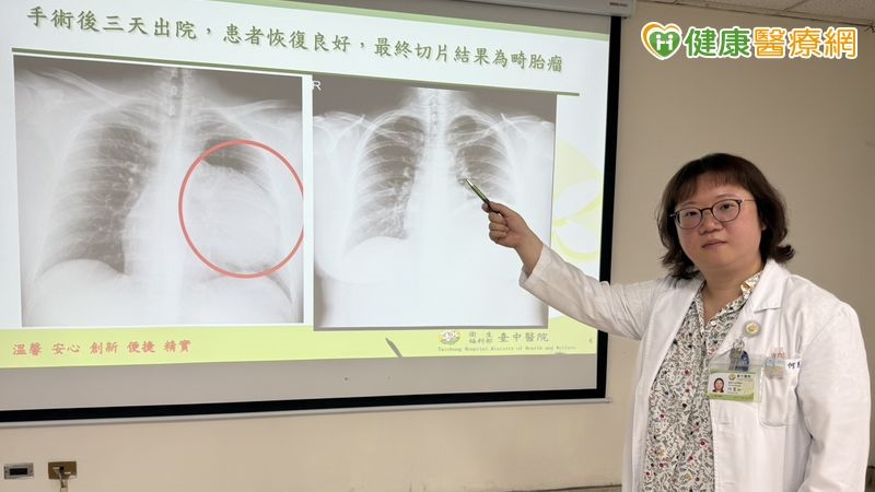 24歲女求職健檢驚見「15公分巨大腫瘤」!肺臟幾乎被壓扁 竟完全沒症狀