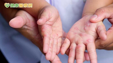 腸病毒就診跌破萬人仍有風險!今年累計7例重症 疾管署籲留意警訊