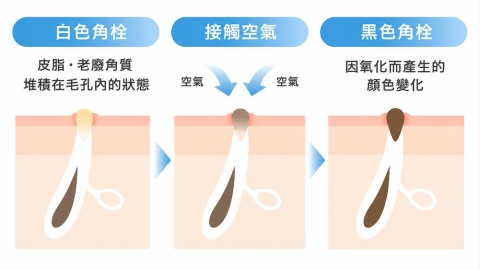 毛孔阻塞的原因是什麼？從今天開始掌握正確的毛孔與角質保養方法