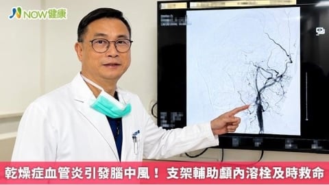 乾燥症血管炎引發腦中風！ 支架輔助顱內溶栓及時救命