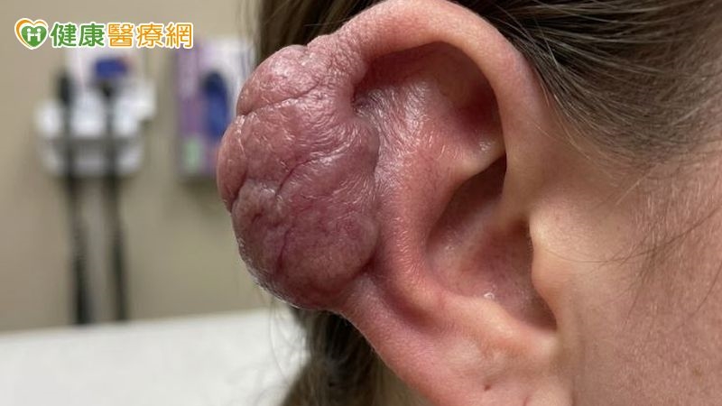 愛美穿耳洞竟長出肉塊　傷口癒合異常恐是「蟹足腫」