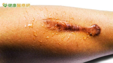 愛美穿耳洞竟長出肉塊 傷口癒合異常恐是「蟹足腫」