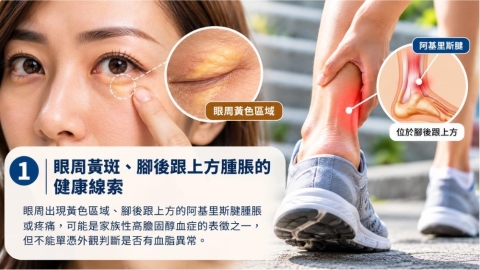 壞膽固醇正常就安心?眼皮長黃斑、腳後跟上方腫脹可能藏著血脂警訊