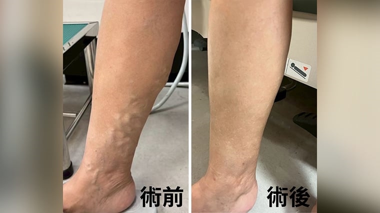 ▲戴女士術前右小腿可見如蚯蚓般突起、凹凸不平的曲張血管,經雷射熱消融合併硬化劑治療後,腿部外觀明顯改善,疼痛症狀也獲得緩解。(圖/長安醫院提供)