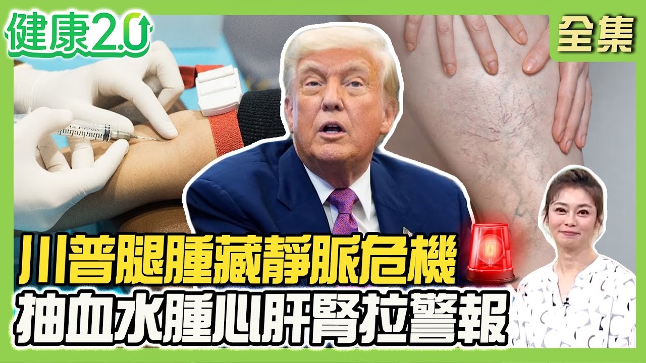 川普腿腫被診斷慢性靜脈功能不全!抽血揪雙腿水腫 3情況恐心肝腎衰竭!老人皮膚莫名瘀青 紫斑症3病徵!